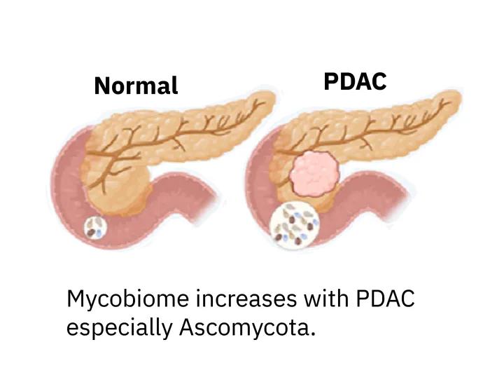 normal pancreas drawing and one labeled PDAC
