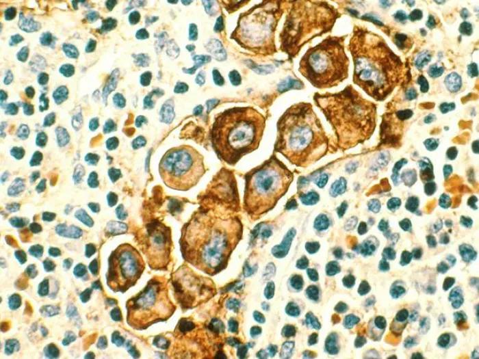 lymph nodes breast cancer under microscope 