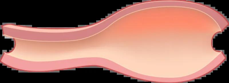 Arterial aneurysm diagram