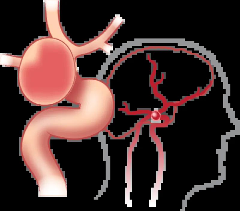Brain aneurysm diagram