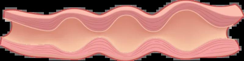 fibromuscular dysplasia diagram