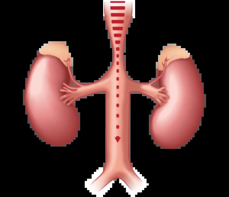 Mid-aortic syndrome diagram