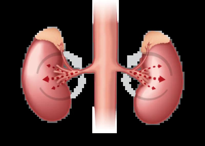 Renovascular hypertension diagram
