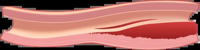 Spontaneous arterial dissections diagram