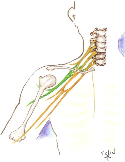 Brachial Plexus Palsy