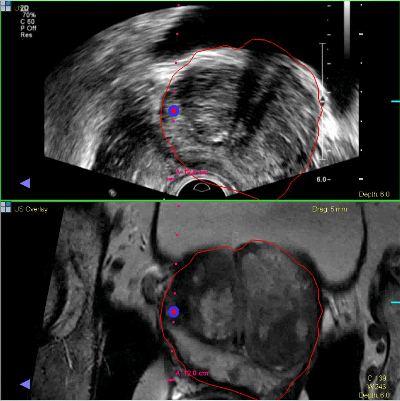 MRI and ultrasound images of prostate