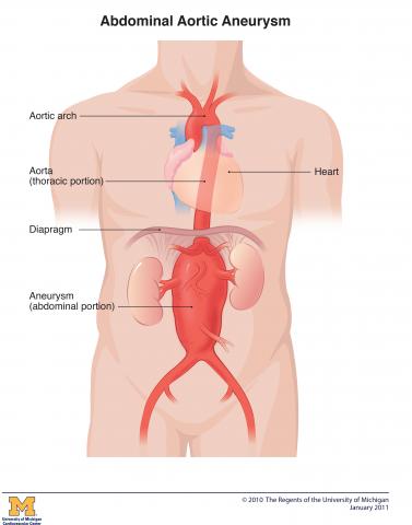 Abdominal Aortic Aneurysm Frankel Cardiovascular Center