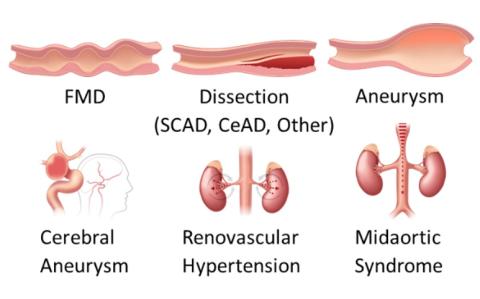 Arterial Dysplasia graphic