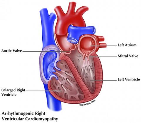 Illustration of ARVC showing enlarged right ventricle of the heart