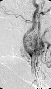 Lateral common carotid angiogram, late arterial phase, showing the tumor vascular blush of a carotid body tumor 
