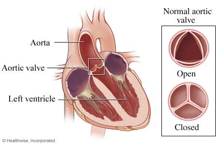 Illustration of heart showing normal aortic valve open and closed