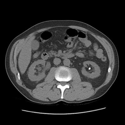 CT scans showing left kidney and right ureteral stones