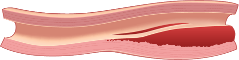 Spontaneous arterial dissections graphic