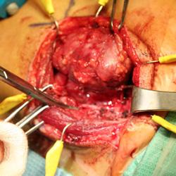Operating room picture of tumor being removed following an embolization procedure  
