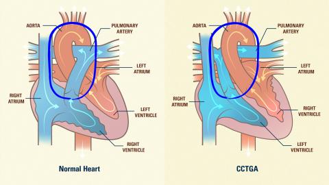 CCTGA Heart Diagram Bloodflow