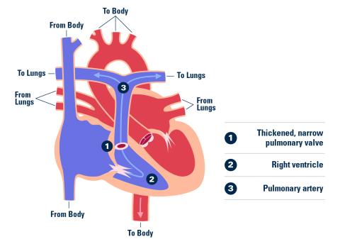 Pulmonary Stenosis graphic