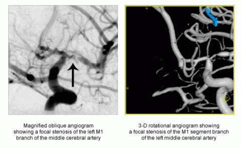 Left: Magnified oblique angiogram showing a focal stenosis of the left M1 branch of the middle cerebral artery  Right:  3-D rotational angiogram showing a focal stenosis of the M1 segment branch of the left middle cerebral artery   