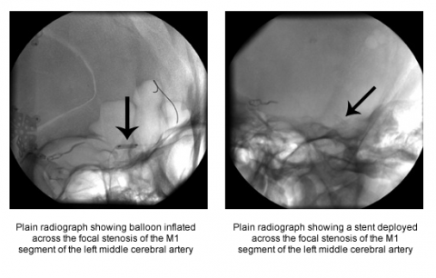 Left: Plain radiograph showing balloon inflated across the focal stenosis of the M1 segment of the left middle cerebral artery  Right: Plain radiograph showing a stent deployed across the focal stenosis of the M1 segment of the left middle cerebral artery