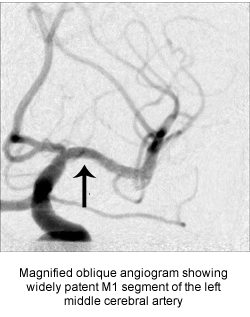 Magnified oblique angiogram showing widely patent M1 segment of the left middle cerebral artery 