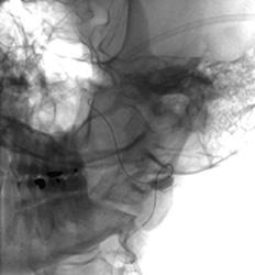 Oblique plain radiograph showing a balloon inflated in the left vertebral artery 
