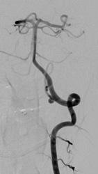 AP left vertebral angiogram prior to a balloon test occlusion and vessel sacrifice