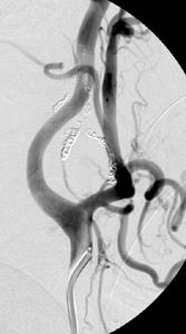Lateral common carotid angiogram showing no tumor vascular blush after embolization 