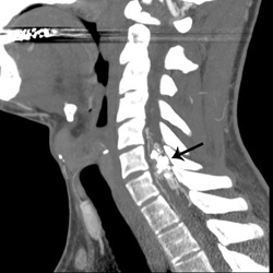 Lateral CT spinal angiogram showing a glue cast in a portion of the spinal intramedullary AVM 