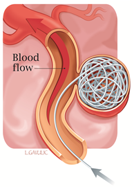Illustration showing detachable coils filling an aneurysm