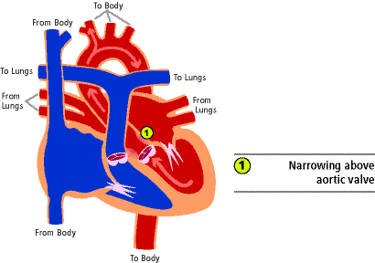 Supravalvar aortic stenosis