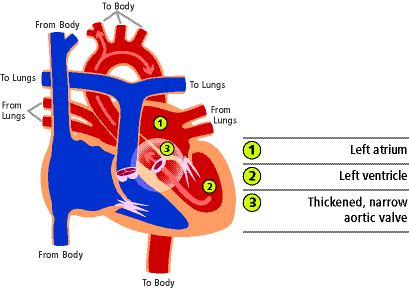 Aortic stenosis, narrowed valve 