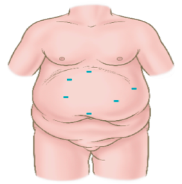 Illustration of body with typical bariatric incision locations