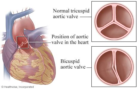 Illustration of bicuspid aortic valve compared to normal tricuspid aortic valve