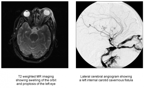 Left: T2 weighted MR imaging showing swelling of the orbit and proptosis of the left eye , Right: Lateral cerebral angiogram showing a left internal carotid cavernous fistula  