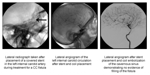 Left: Lateral radiograph, Center Lateral Angiogram, Right:  Lateral Angiogram