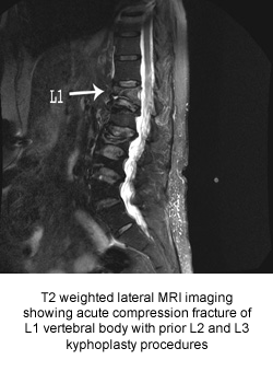 T2 weighted lateral MRI imaging showing acute compression fracture of L1 vertebral body with prior L2 and L3 kyphoplasty procedures 