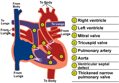 Corrected transposition of the great arteries, illustration