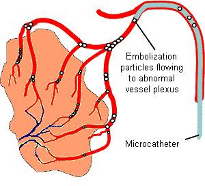 Schematic diagram showing particulate embolization