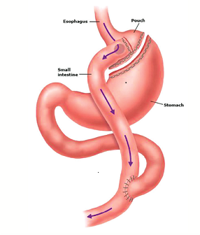 Illustration showing incision, pouch and new digestive path created in gastric bypass surgery