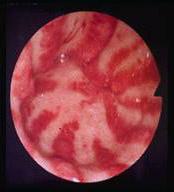 This is a photograph of watermelon stomach taken during an endoscopy procedure