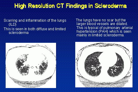 Lung of patient with scleroderma