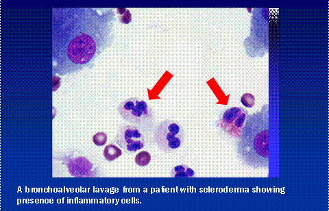 A brochoaveolar lavage from a patient with scleroderma