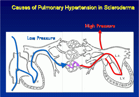 Causes of Pulmonary Hypertension in Scleroderma