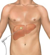 graphic of treatment needle inserted to liver