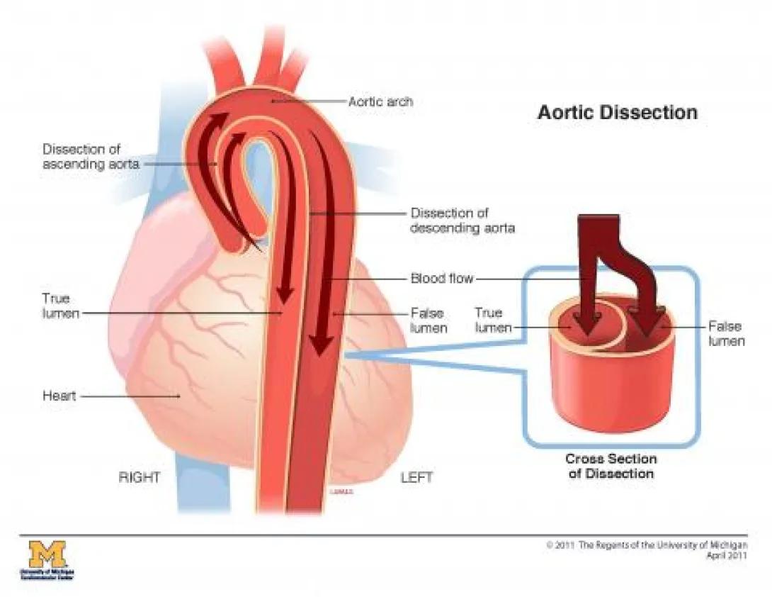 diagram of the heart and aortic dissection