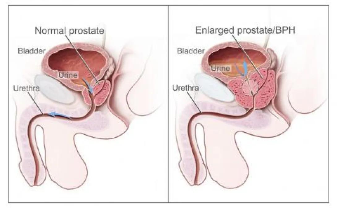 anatomy of enlarged prostate vs normal