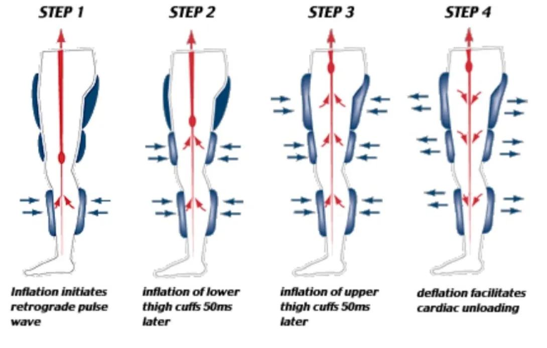 Enhanced External Counter Pulsation treatment graphic