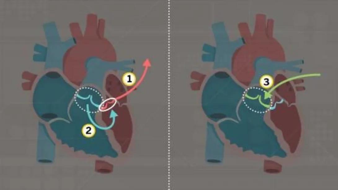 Medical illustration showing mitral valve repair procedure with numbered steps comparing before and after heart anatomy for cardiac surgery education.