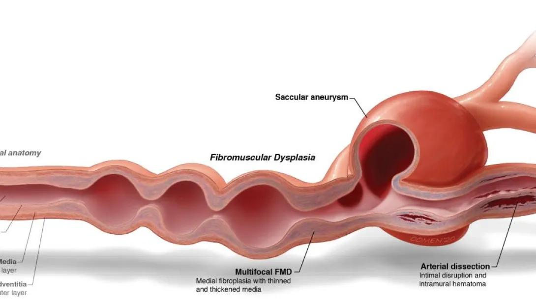 Diagram arterial dysplasia overview