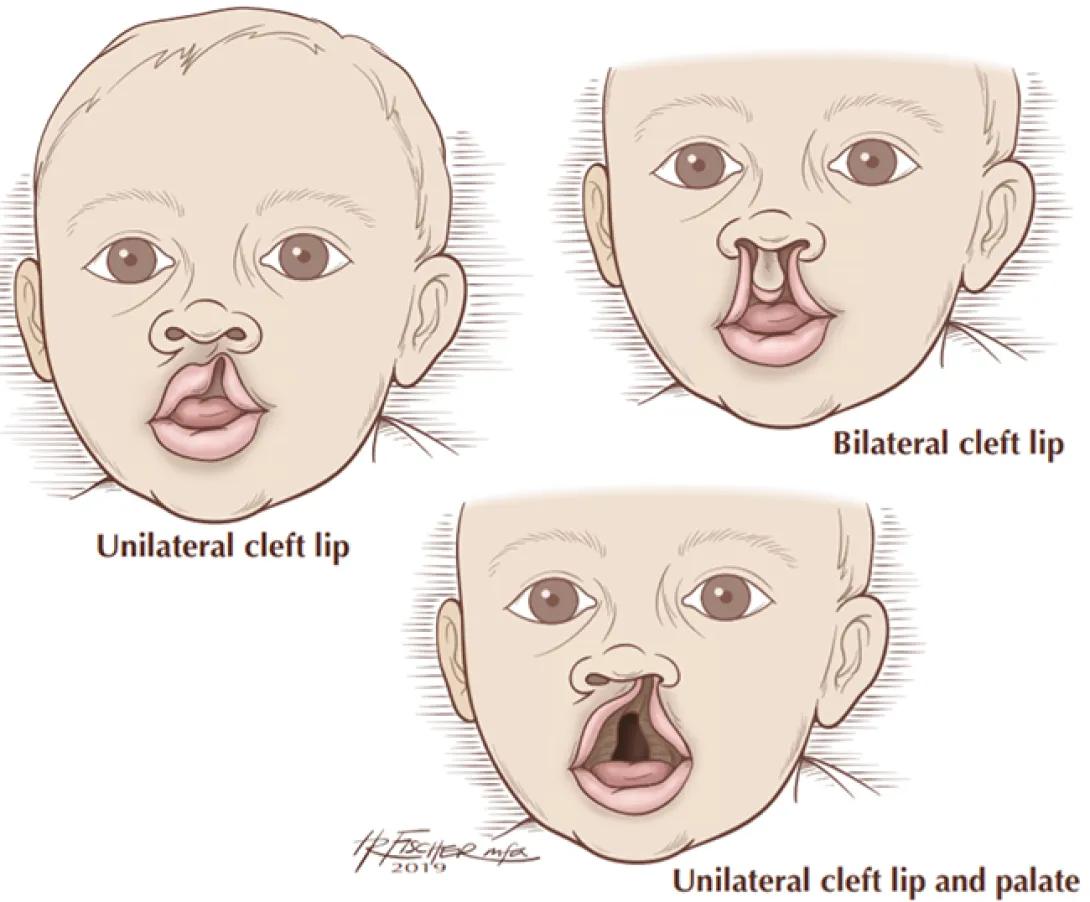 Diagram of 3 different types of cleft palate on infant