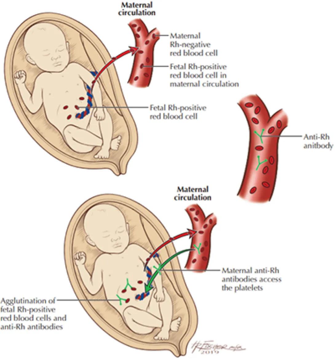 Hemolytic disease of the newborn diagram